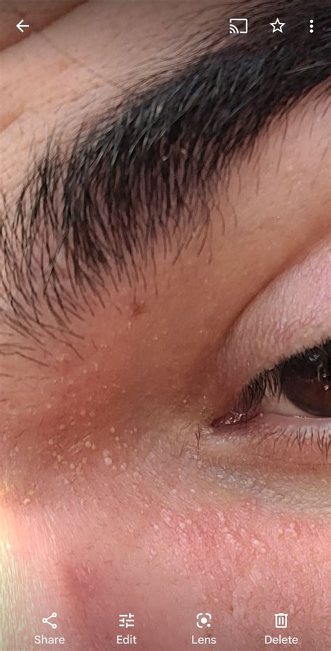 Eye shingles? : r/shingles