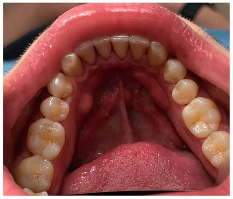 Oral Tori Findings in an Adult Albanian Population: A Single-Center Pilot Study