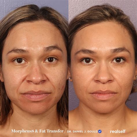 Fat Transfer to Face Procedure & How Long Results Last | Face procedures, Fat transfer, Fat grafting