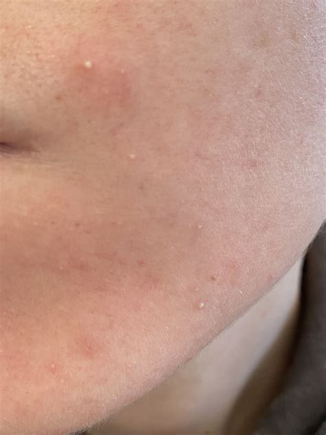 Gram Negative Folliculitis? - Acne - Acne.org Forum