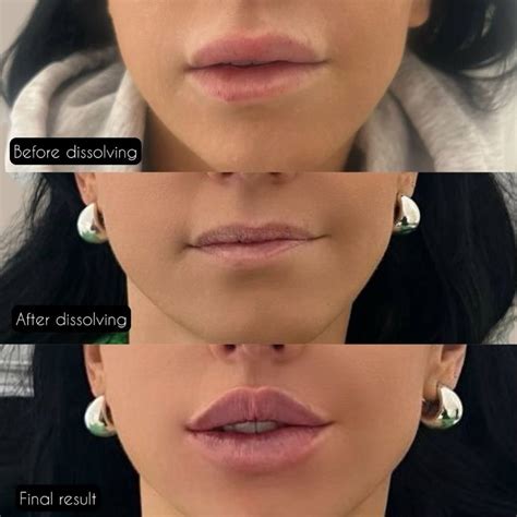 Hyalase Lip Filler Dissolving London | Alta Medispa