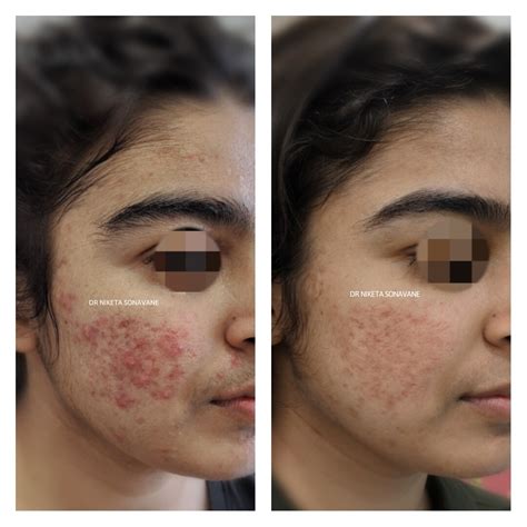 Dermatologist Before And After Acne