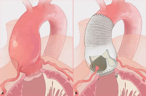 Aortic root geometry following composite valve graft implantation: Implications for future valve ...