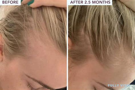 Microneedling Before and After: A Comprehensive Guide for Hair Growth Stimulation | FullyVital