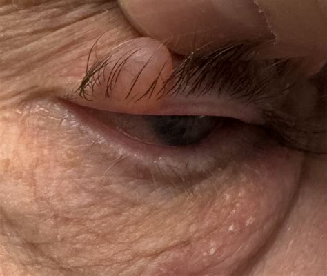 Eyelid Bump Types Causes And Treatment Eyelid Lumps And Bumps | Eye