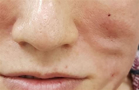 Avoid Thread Lift Gone Wrong from Diaminy Supplier