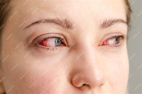 Premium Photo | Close up of red irritated human eyes allergy symptom conjunctivitis