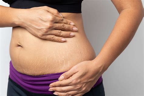 Stretch Marks & Weight Loss: Everything You Need To Know - SOG Health Pte. Ltd.