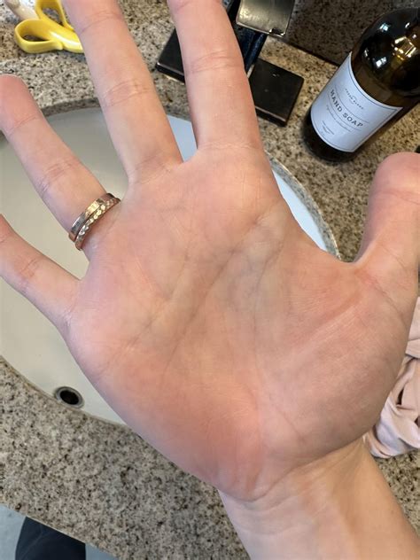 Veins on palms : r/dysautonomia