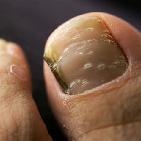 How to avoid toenails yellowing and falling off | Foot & Ankle Center ...