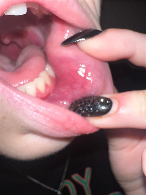 21F recent bloodwork fine, tissue bump in mouth with canker sore, cheek is sore, I’m scared the ...