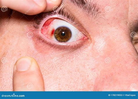 Throwing Up Blood Vessel Eye at Stephanie Daley blog