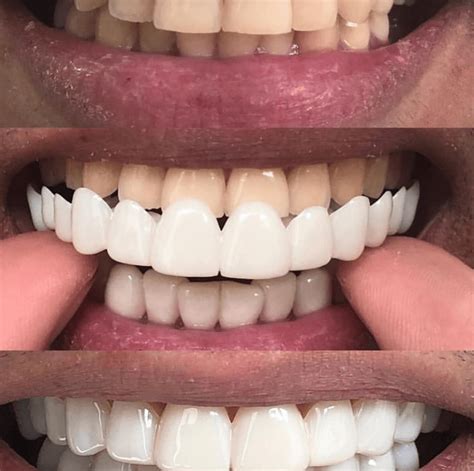 What are clip on veneers? | News | Dentagama | Perfect teeth braces ...