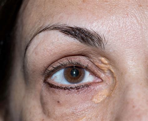 Xanthelasma: correction of fatty deposits on the eyelids