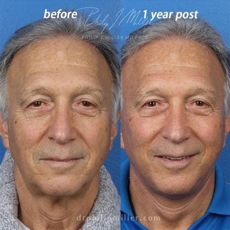 Plastic Surgery for Men - Gotham Plastic Surgery