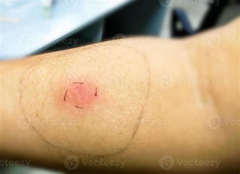 Mantoux vaccination, Closeup view photography of patient arm with red ...
