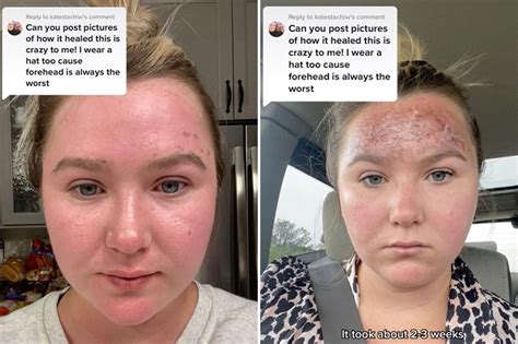I was severely burned after using expired sunblock