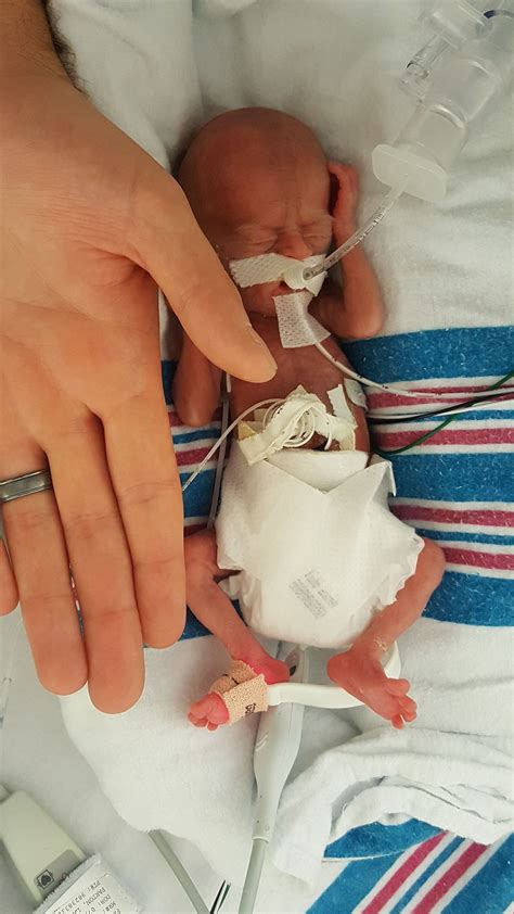 Bebes Prematuros 26 Semanas