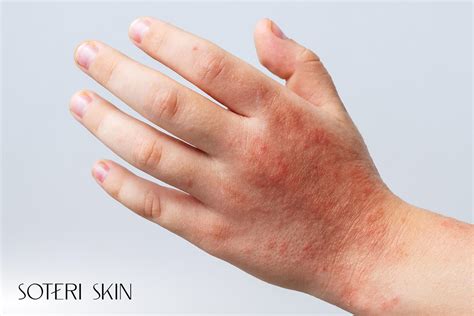 Understanding Different Types of Eczema: Symptoms, Causes, and Effective Treatments