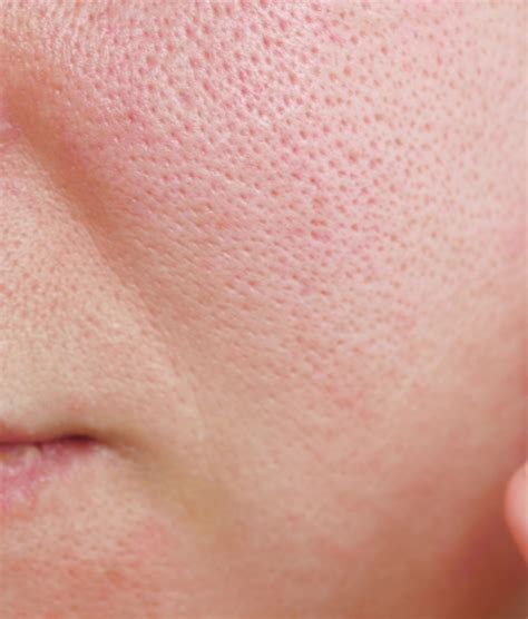 Enlarged Pores