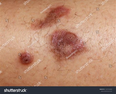 Hypertrophic Lichen Planus