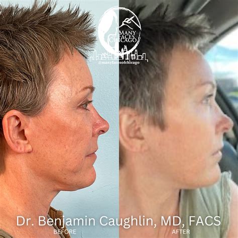 PERIORAL MOUND TREATMENT BEFORE & AFTER GALLERY