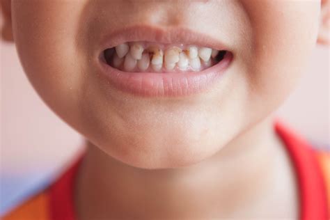 Dental Caries In Pediatric Dentistry at Nathaniel Ackerman blog