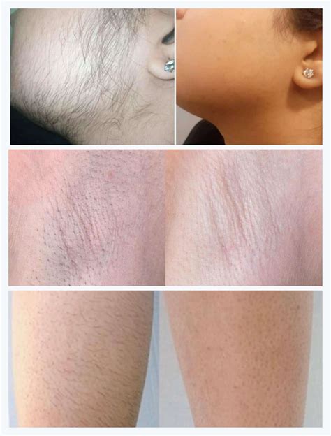 Laser Hair Removal in Riyadh, Saudi Arabia (Prices & Offers)