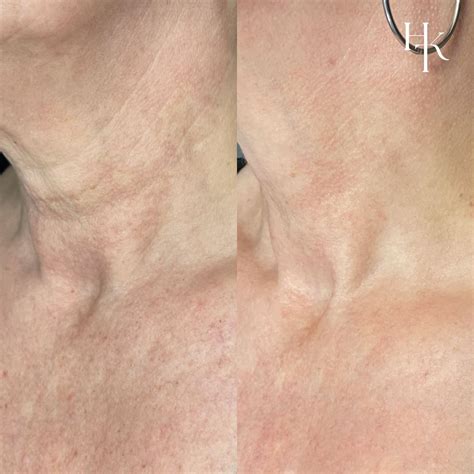 Poikiloderma van Civatte - Huidkliniek Twente