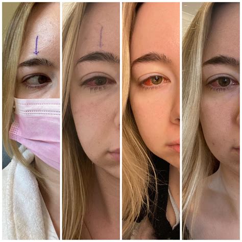 Prism Glasses After Strabismus Surgery at Julian Fairfield blog