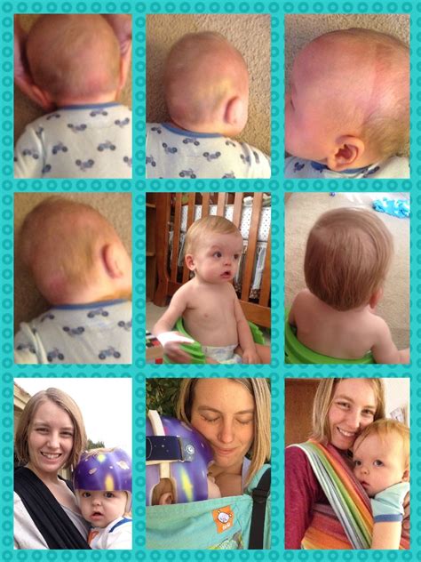 Why Do Babies Have To Wear Helmets | Renew Physical Therapy