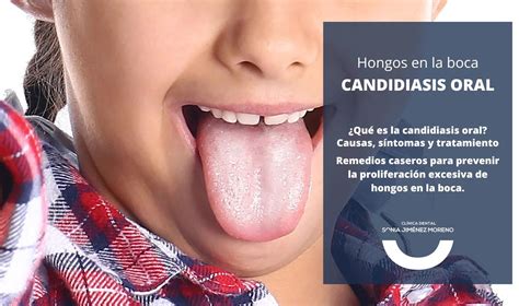 Candidiasis Oral: Causas, Síntomas Y Tratamiento | Doctor Online