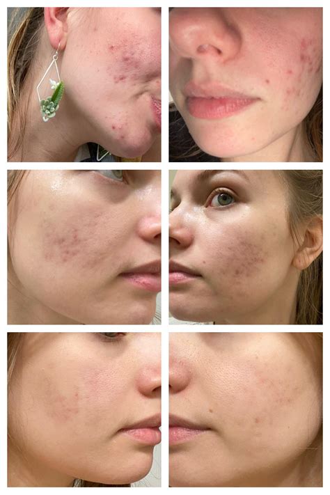 Cystic Acne Chin Scars
