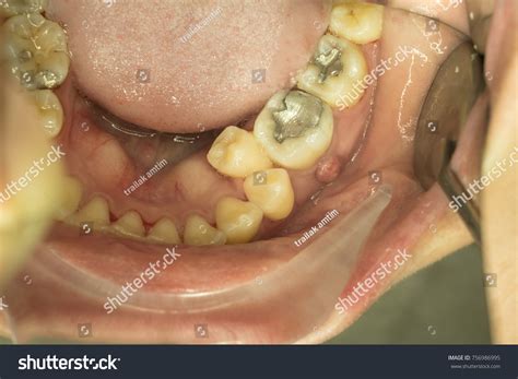 Periapical Abscess Fistula