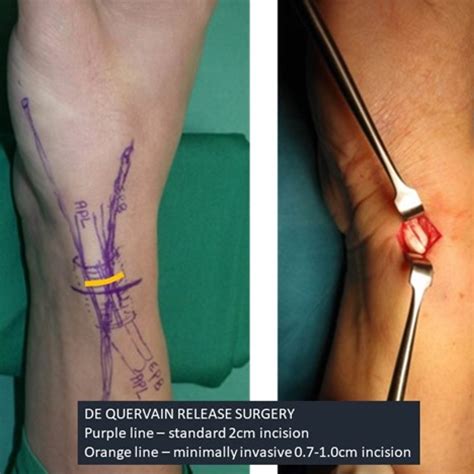 De Quervain's Surgery Cost at Mary Bevis blog