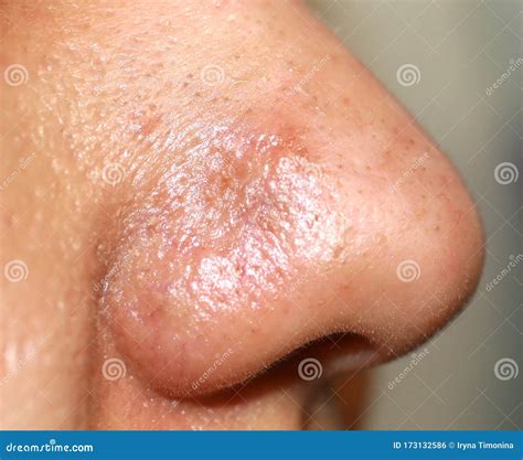 Inflamed Pimple on Nose. Cyst Acne Stock Photo - Image of clogged ...