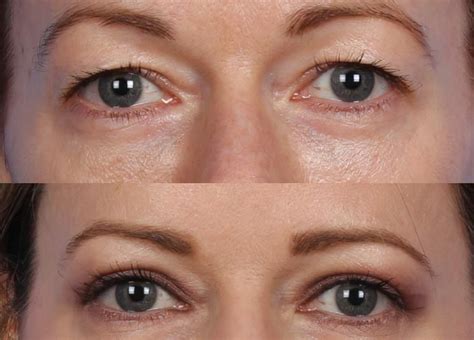 What Causes Hooded Eyelids
