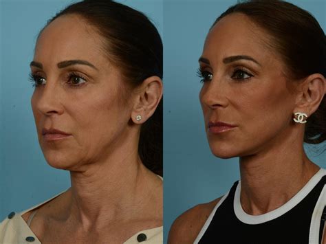 ‘Ozempic® Face’: What To Do About Facial Aging and Sagging Skin After Weight Loss – TLKM Plastic ...