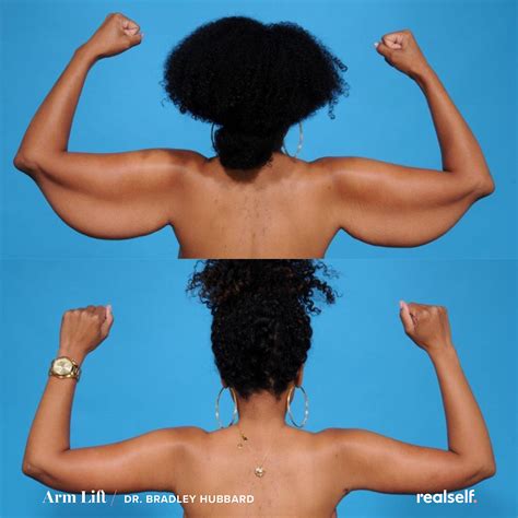 Arm Lift: What to Expect, Risks, Recovery | RealSelf | Skin removal surgery, Skin tightening ...
