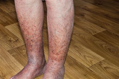 Dermatitis ocre en bota: causas, síntomas y tratamiento | Bucanero Calzados