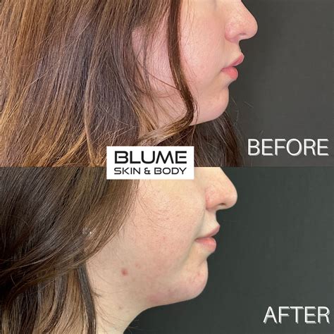 Patient 1933 Before & After Photos Scottsdale, AZ