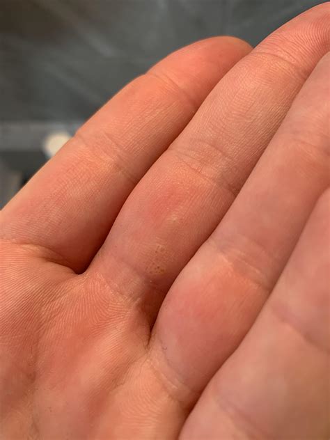 Why Do I Have Little Bumps On My Areola at Tim Sherman blog