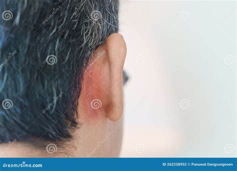 Seborrheic Dermatitis Ear