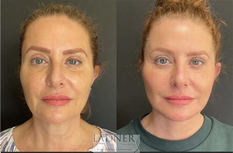 Fat Injections In Face Surgery Online | varsana.com