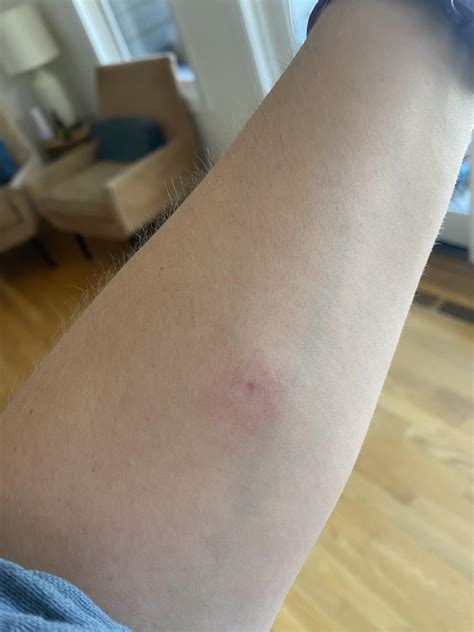 Tb Positive Test Looks Like