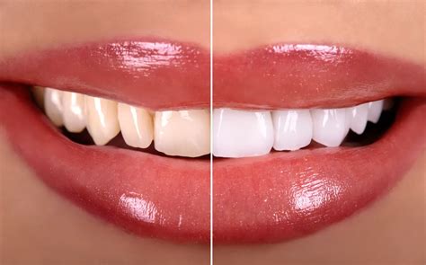 Whitening & Veneers for Newark and East Orange, NJ | Nova Dental ...