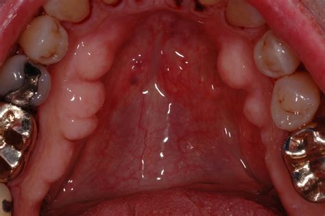 The Buzz from Your Favorite Dental Hygienists: Exostosis