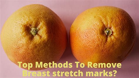 Top Methods To Remove Breasts stretch marks?