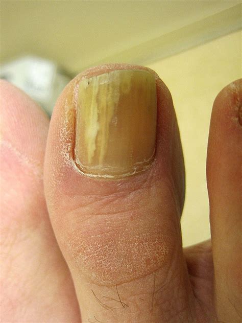 Why Do My Toenails Have White Spots at Otto Atkinson blog