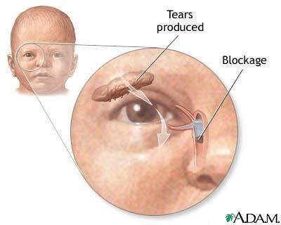 Eye Discharge in the Newborn